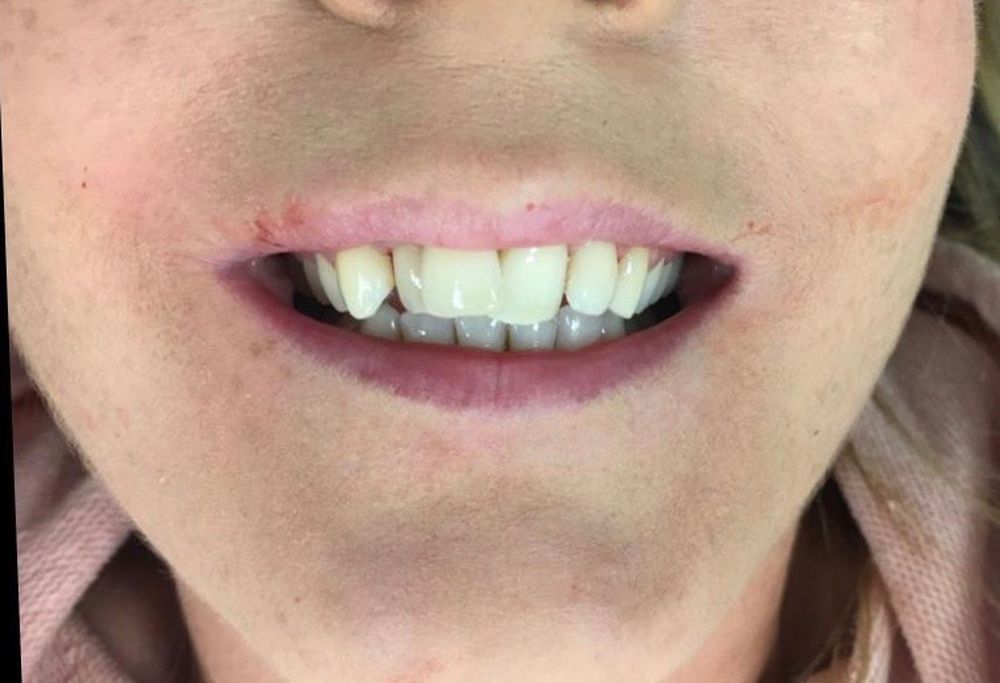 donna-6-month-braces-before